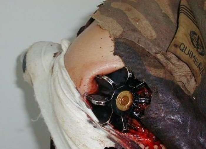 Мінометна міна застрягла в плечі військовослужбовця (3 фото)