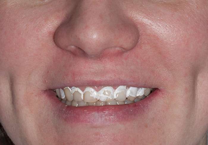 Чого варто чекати від засобів моментального відбілювання зубів (10 фото)