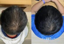 Serum na bazie ekstraktów roślinnych przyspiesza wzrost włosów w ciągu kilku tygodni.